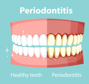 Diabetes and Periodontal Disease